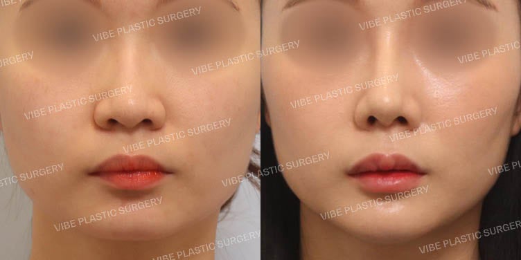 هل يمكن تصحيح بروز الفم من خلال تجميل الأنف فقط؟ تصحيح بروز الفم في عيادة فايب للتجميل!