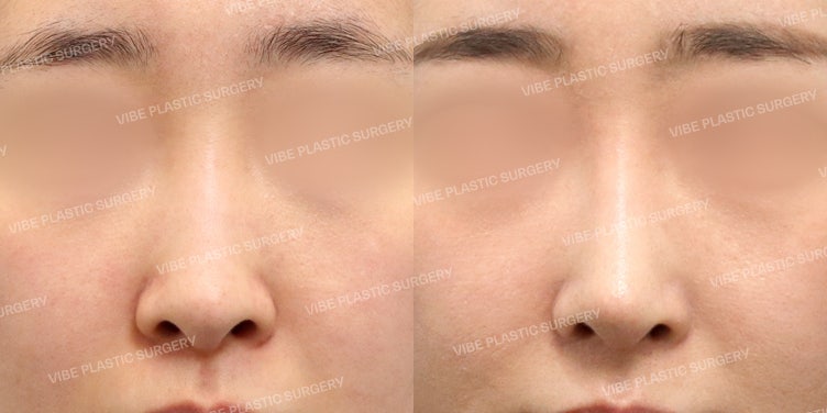 VIBE Plastic Surgery for a Glamorous Straight-Semi-Curved Nose! (Correction of Drooping Columella and Dragon Nose)