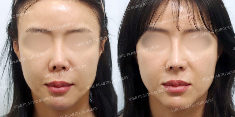 แก้จมูกสั้นและลดปีกจมูก (Alar Retraction) เพื่อทรงจมูกที่สวยหรูดูแพง! :D