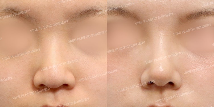 Worried About a Drooping Tip? VIBE Plastic Surgery is the Choice for Implant-Free Rhinoplasty :)