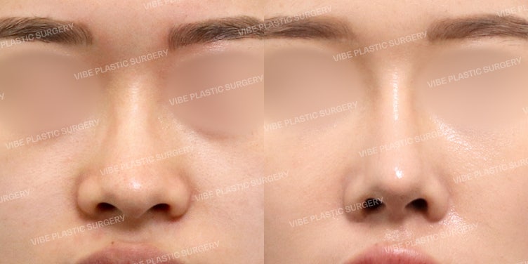 แก้ไขจมูกบานและจมูกงุ้มที่ Vibe Plastic Surgery :D (ต้นแบบความสวยแบบคุณคาริน่า)