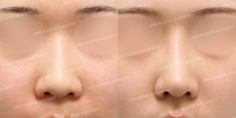 Correcting a Blunt Bulbous Nose at VIBE Plastic Surgery! (The Standard of a Sophisticated Straight-Ogee Line)