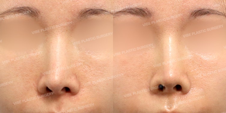 แก้ไขจมูกเบี้ยวและรูจมูกไม่เท่ากันที่มีความยากสูง ที่ VIBE Plastic Surgery!