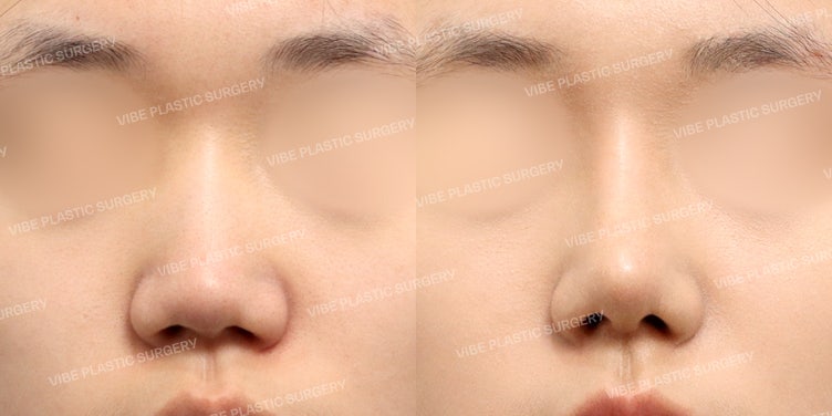 ปรับแก้จมูกชมพู่และฐานจมูก (Columella) เพื่อใบหน้าที่มีมิติ (ศัลยกรรมจมูกชมพู่ที่ VIBE Plastic Surgery)