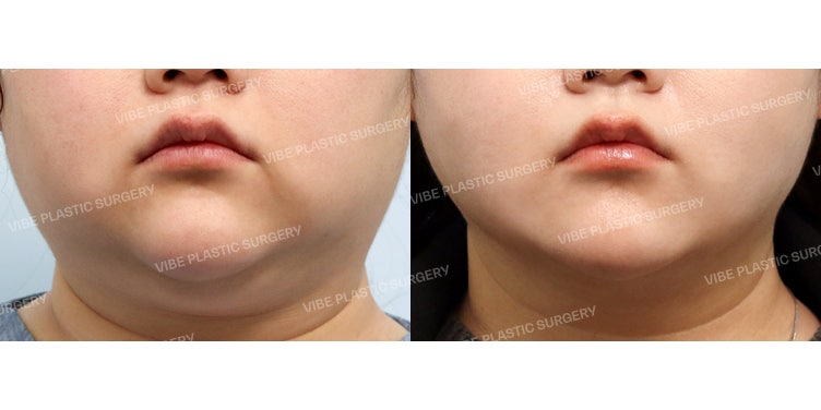 VIBE Plastic Surgery’s ‘LipoSound’ V-Line Project: Amazing Results!