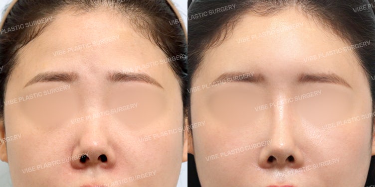 ปรับแก้จมูกสั้นพร้อมเติมวอลลุ่มหน้าผาก สร้างมิติใบหน้าที่ดูหรูหราและมีระดับ!