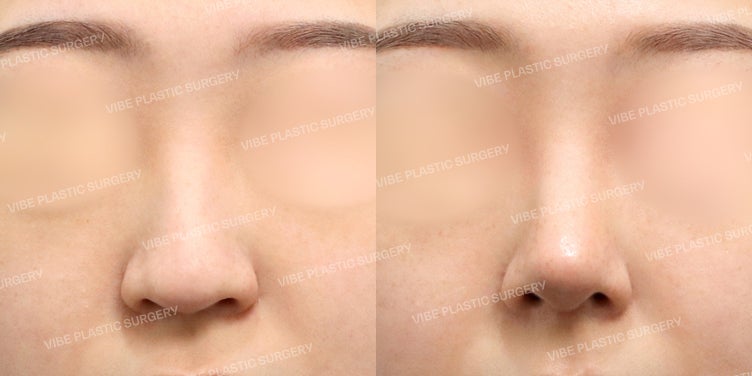 تجميل الأنف بدون غرسات في عيادة فايب: استخدام الغضاريف الطبيعية فقط