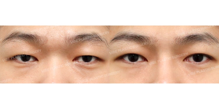 แก้ไขกล้ามเนื้อตาแบบไม่เห็นชั้นตาสำหรับผู้ชาย ที่ VIBE Plastic Surgery!