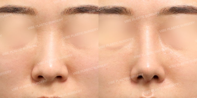 จมูกที่ดูธรรมดาจะเปลี่ยนเป็นสวยคมได้ไหม? เป็นไปได้แน่นอนที่ VIBE Plastic Surgery :D