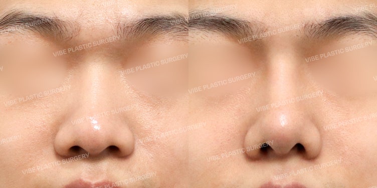 عملية تجميل الأنف العريض للرجال بشكل طبيعي في عيادة فايب (VIBE) :D (+ عملية الأنف الوظيفية)