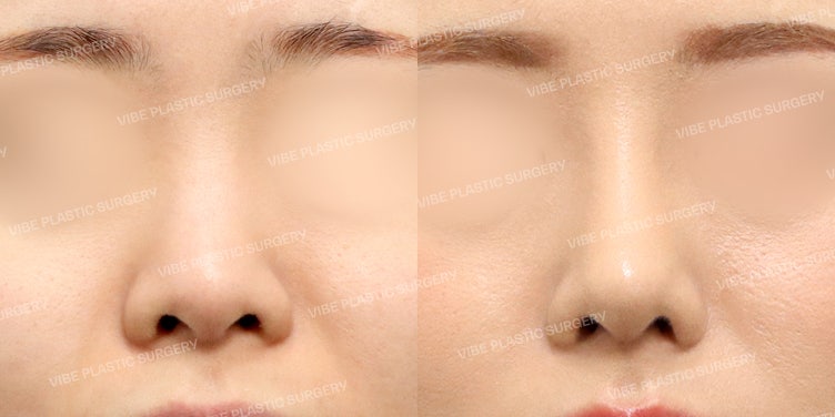 Dáng mũi thẳng tự nhiên và sang trọng tại Vibe Plastic Surgery!