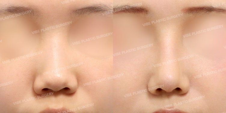 VIBE Plastic Surgery’s Signature 💎 Straight-Semi-Curved Nose Line :D – Sophisticated Facial Transformation via Bulbous Nose Correction –