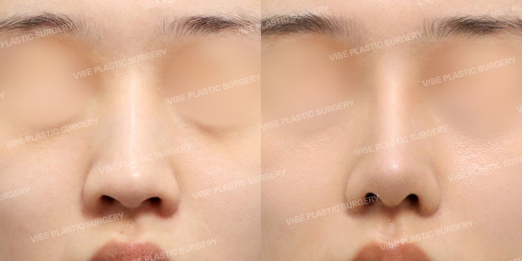 เพิ่มความ ‘โดดเด่น’ ให้กับความสวยที่เป็นธรรมชาติ!! - ศัลยกรรมจมูกที่ VIBE Plastic Surgery :D