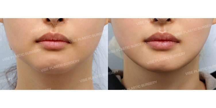 สำหรับคนรูปร่างผอมแต่กังวลเรื่องคางสั้น!! - รีวิวการสร้างกรอบหน้าเรียวสวยด้วยอัลตราซาวด์ LipoSound และการร้อยไหม!