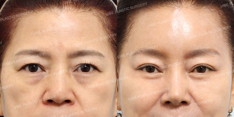 Phụ nữ U60 lột xác trẻ trung tự nhiên! Review «Nâng cung mày nội soi & Cắt mí bán phần & Tạo hình mi dưới» tại Vibe Plastic Surgery 🌟