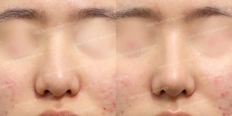 تجربة عملية تجميل الأنف بدون غرسات صناعية — تصحيح طبيعي وأنيق لطرف الأنف! (تصحيح الأنف الطويل والأنف العريض) 🎀
