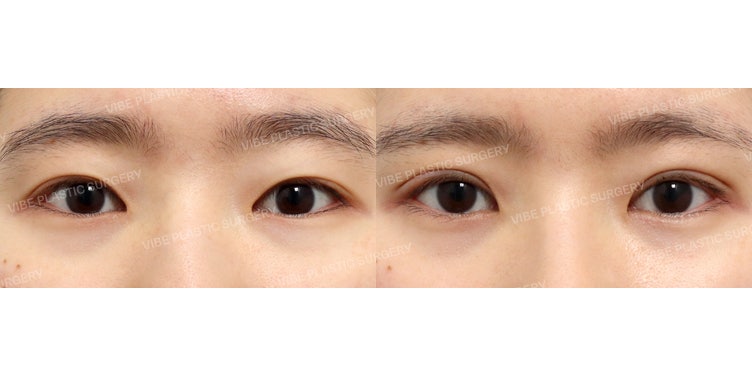 👁 眠たそうな目？10代でも可能な非切開目つき矯正