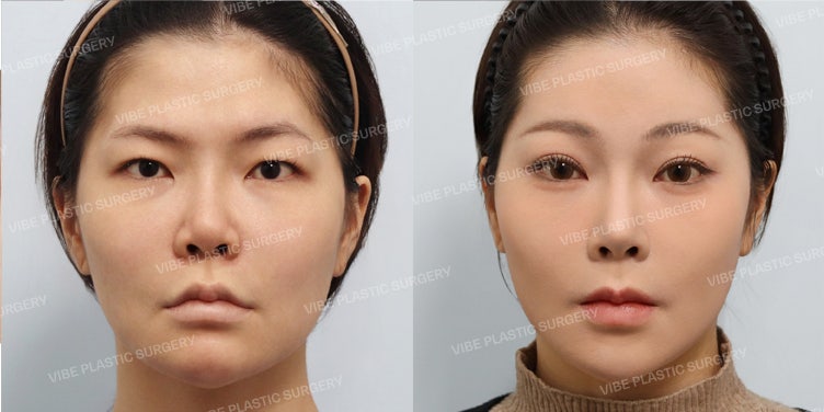 👩‍⚕️ Phẫu thuật mắt lần đầu & Tái phẫu thuật mũi, thay đổi ấn tượng cho phụ nữ tuổi 20 «Nâng cung mày nội soi + Cắt mí / Tái phẫu thuật mũi bằng sụn sườn tự thân»