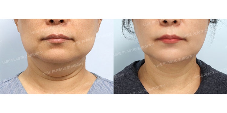 Wanita Usia 50-an, Perubahan Sebelum & Sesudah Prosedur Perbaikan Double Chin dan Kerutan Leher! (Liposound + Pengencangan Otot + Perbaikan Kerutan)