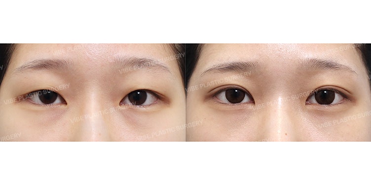 เคสทำตาสองชั้นแบบกรีดจุด (Partial Incision) สำหรับนักเรียนมัธยม! ผลลัพธ์ดวงตาสวยคมชัดดูเป็นธรรมชาติ :)