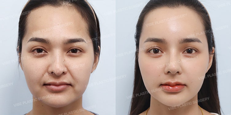 🌸 วัยใสวัย 20 อัพลุคใบหน้าให้น่ารักสมบูรณ์แบบ! - นพ. ยูยองมุน VIBE Plastic Surgery