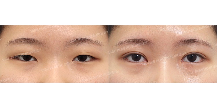 👁 Hoàn thiện đôi mắt sắc nét và đầy sức sống với đường rạch tối thiểu «Chỉnh hình sụp mí bán phần»