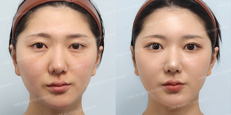 VIBE Plastic Surgery's No-Implant Rhinoplasty (DANYEONKO) & Fat Grafting Case