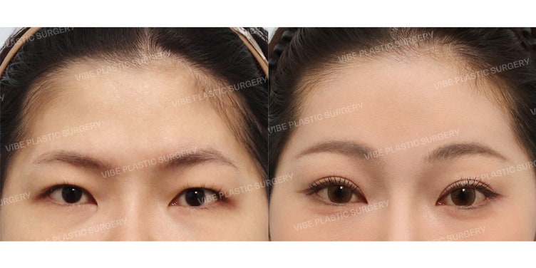 กังวลเรื่องใบหน้าที่ดูอึดอัดและดุเกินไป (feat. ยกคิ้ว & ทำตาสองชั้น)