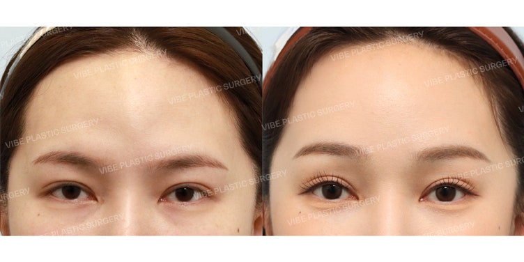 ปรับลุคให้ดูละมุนด้วยการยกหน้าผากผ่านกล้องเอ็นโดสโคป โดย นพ. ยู ยองมุน VIBE Plastic Surgery