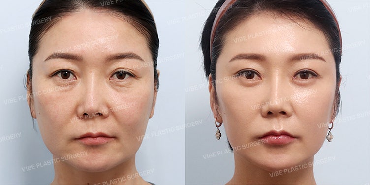 تجربة جراحة التجميل لاستعادة الشباب في الأربعينيات – تحول كامل من الجبهة إلى الرقبة لشد طبيعي ومظهر متجدد!
