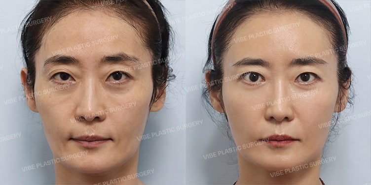 حالة جراحة تجميل العين وحقن الدهون لامرأة في الخمسينيات – تأثير شبابي بمظهر طبيعي