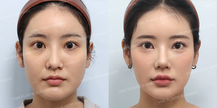 [바이브 성형외과] 무보형물 코성형으로 완성한 자연스러운 코라인 – 하이코 시술로 만족할 수 없었던 20대 여성분의 케이스 ✨