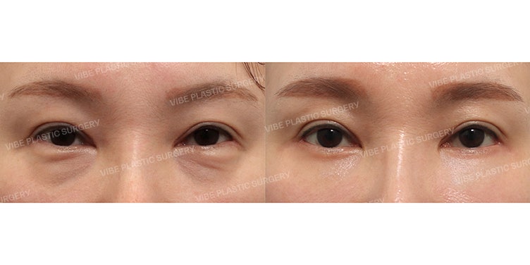รอยคล้ำใต้ตาและแก้มตอบในวัย 40 ฟื้นฟูความอ่อนเยาว์อย่างเป็นธรรมชาติด้วยการผ่าตัดตาล่าง + ดึงหน้าส่วนกลาง!