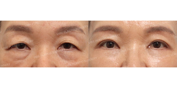 Wanita Usia 50-an, Tampil Muda Secara Alami! (1. Lower Blepharoplasty & Mid-face Lift 2. Subbrow Lift & Double Eyelid Insisi Parsial)