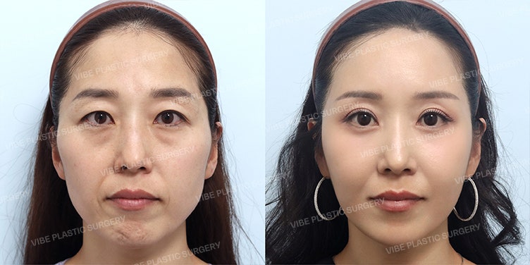 Tampil Muda Alami di Usia 40-an dengan Pengencangan Mata dan Midface Lift - VIBE Plastic Surgery Lifting & Wellness Center
