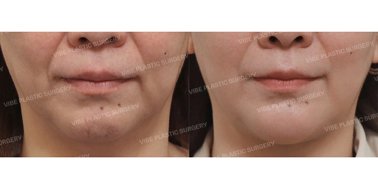 💆‍♀️ Kasus Perbaikan Double Chin dan Garis Rahang Kendur pada Wanita Usia 50-an (1. Liposuction LipoSound & Pengikatan Otot 2. Lifting Kombinasi Benang Mint & Silhouette Soft) oleh dr. Yoo Young-moon, VIBE Plastic Surgery