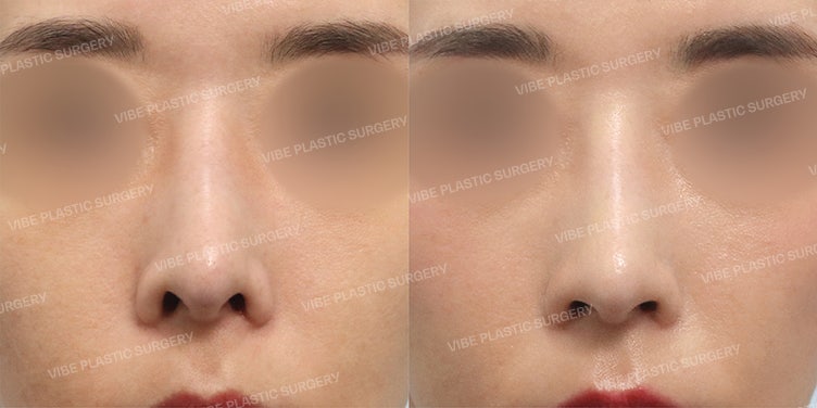 👃 Koreksi Lubang Hidung Bentuk Naga (Dragon Nostrils) — Penurunan Alar (Nostril Lowering) oleh Dr. Yoo Young-moon, Vibe Plastic Surgery