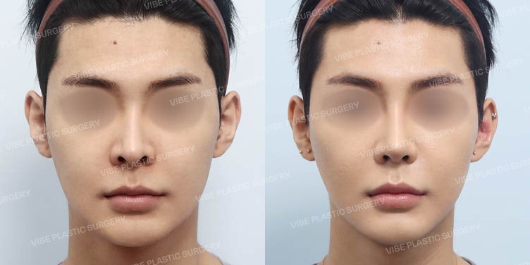 ศัลยแพทย์ ยูยองมุน แห่ง Vibe Plastic Surgery: 👃 ลดการมองเห็นรูจมูก! ทรงจมูกผู้ชายต้องเป็นทรงตรง!