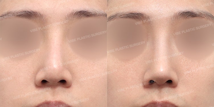 VIBE Plastic Surgery: 👃🏻 إعادة عملية تجميل الأنف لرجل في الثلاثينيات باستخدام غضروف الضلع الذاتي (قبل وبعد)