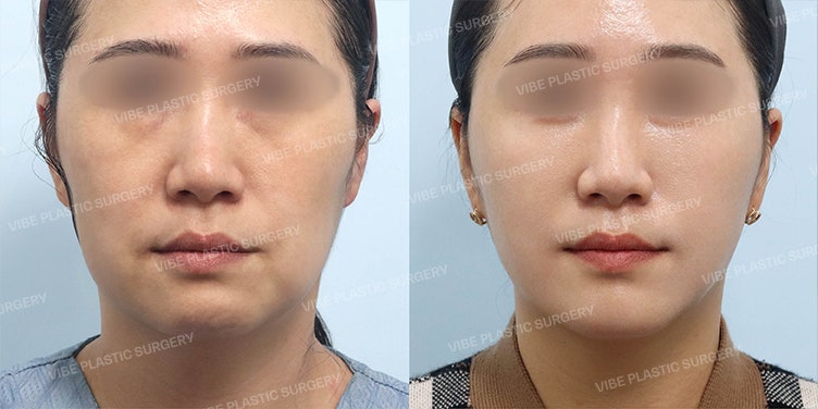 Nỗi lo «mặt chảy xệ & mặt vuông» ở phụ nữ tuổi 30: 1. Căng da mi dưới & tầng mặt giữa 2. Căng da Mini SMAS bởi Bác sĩ Yoo Young-moon, Thẩm mỹ viện VIBE