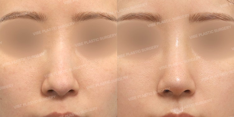 📌 เสริมจมูกแบบไม่ใช้ซิลิโคน - จมูกสวยได้แม้ไร้สิ่งแปลกปลอม โดย นพ. ยู ยองมุน VIBE Plastic Surgery