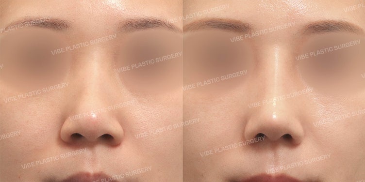 Ringkasan Keunggulan Rhinoplasty Tulang Rawan Iga Sendiri (Alasan Mengapa Koreksi Hidung Lebar dan Sudut Nasolabial Diperlukan) - Dr. Yoo Young-moon, VIBE Plastic Surgery