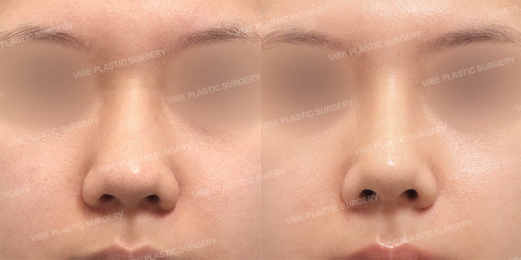 ศัลยกรรมจมูกครั้งแรก โดยคุณหมอยูยองมุน VIBE Plastic Surgery | แก้ไขจมูกฮัมพ์และจมูกชมพู่ในหญิงสาววัย 20 ที่เคยมีจมูกใหญ่และดูหนา