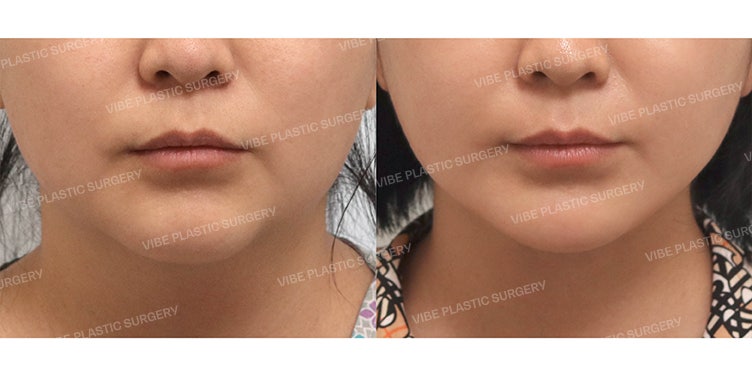 Vibe Plastic Surgery: A Global Destination | Double Chin Liposuction + Thread Lift Case Study - Dr. Young-moon Yu
