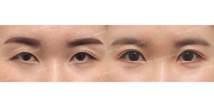 Memperbaiki Mata yang Terlihat Sempit (Kasus Koreksi Kelopak Mata Non-Insisi + Canthoplasty Belakang & Bawah) oleh Dr. Yoo Young-moon, Vibe Plastic Surgery Gangnam