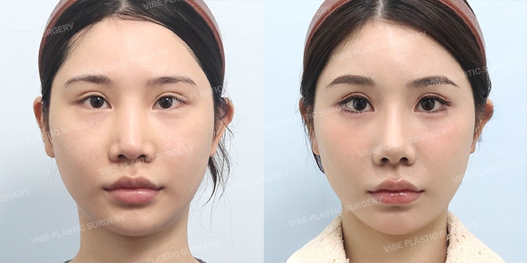 鼻中隔での鼻整形後に物足りなさを感じたら？｜自家肋軟骨で確実になった華やかでナチュラルな直半鼻ライン by 新論峴駅バイブ整形外科 ユ・ヨンムン院長
