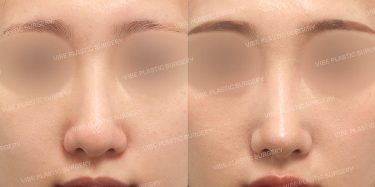 عملية تجميل الأنف الطويل بدون غرسات صناعية | تحسين طول منتصف الوجه عبر تجميل الأنف الطبيعي - د. يو يونغ-مون، عيادة فايب للتجميل
