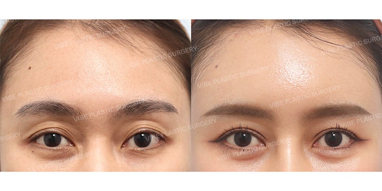 Improving Sunken Eyelids and Multiple Folds (Achieving Defined Eyes with Incisional Ptosis Correction + Upper Eyelid Fat Grafting) by Dr. Young Moon Yoo, VIBE Plastic Surgery
