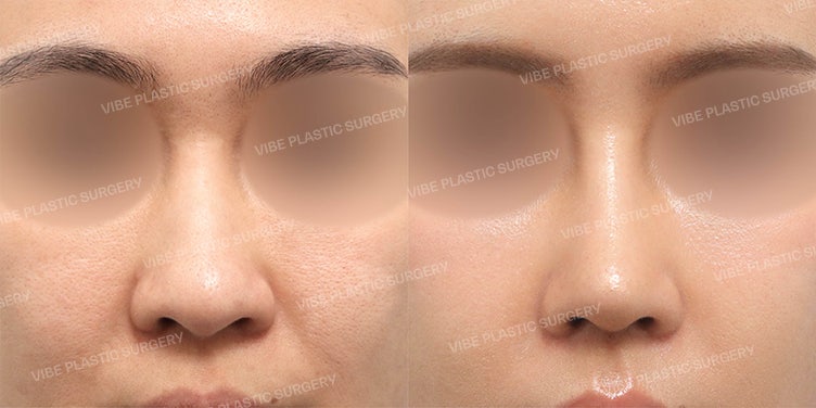 عملية تجميل الأنف الأولى بغضروف الضلع الذاتي (تصحيح الأنف العريض، تدلي طرف الأنف، وزاوية الأنف والشفة) / لماذا يختار البعض غضروف الضلع منذ العملية الأولى؟ بقلم الدكتور يو يونغ-مون، مدير عيادة فايب للتجميل