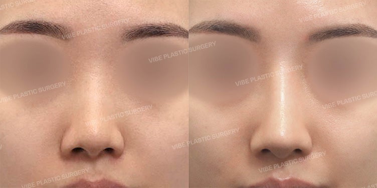 Rhinoplasty Case: Resolving a Bulbous Nose After Filler and Hiko Thread Lift (by Dr. Young-moon Yoo, VIBE Plastic Surgery)